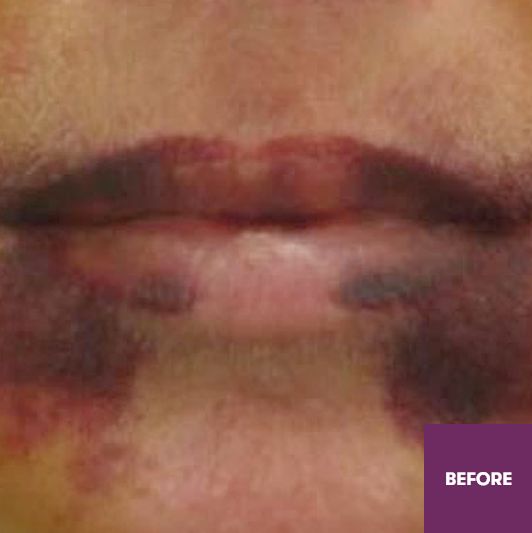 Result Before Treatment