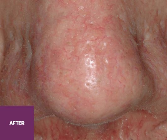 Result After Treatment