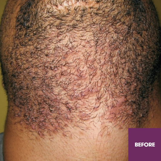 Result Before Treatment
