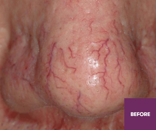 Result Before Treatment