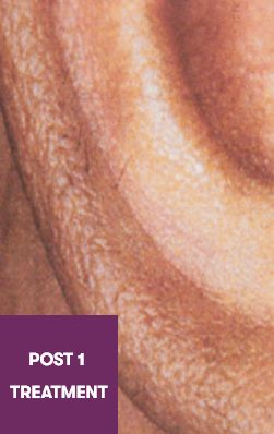 Result After Treatment
