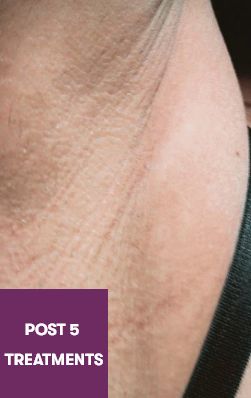 Result After Treatment