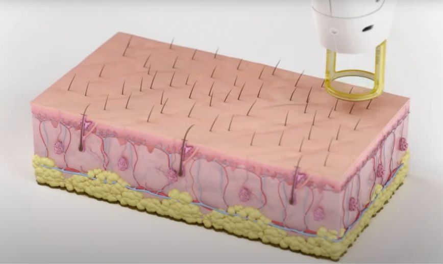 Gentle Pro Product Video Image