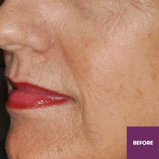 Result Before Treatment