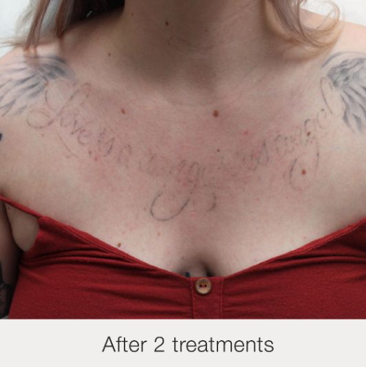 Result After Treatment