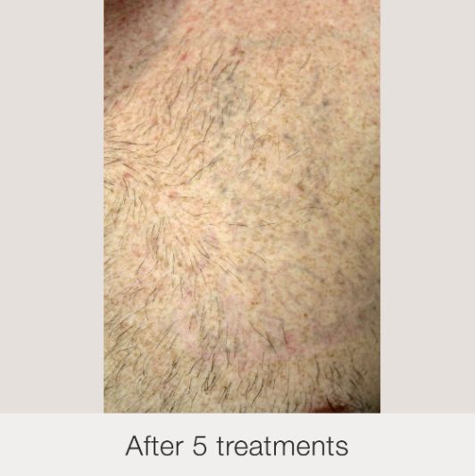 Result After Treatment