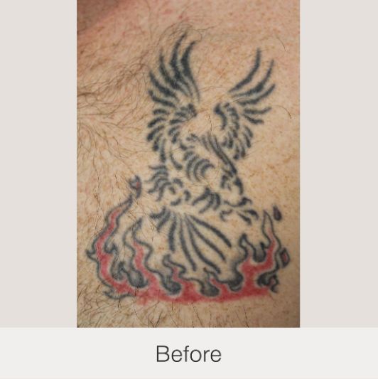 Result Before Treatment
