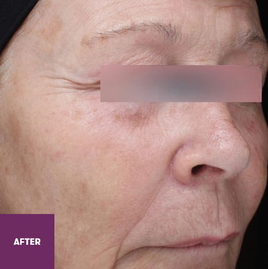 Result After Treatment
