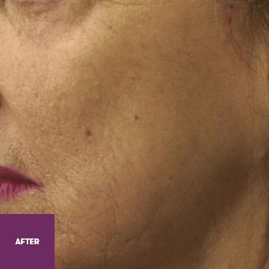 Result After Treatment