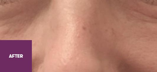 Result After Treatment