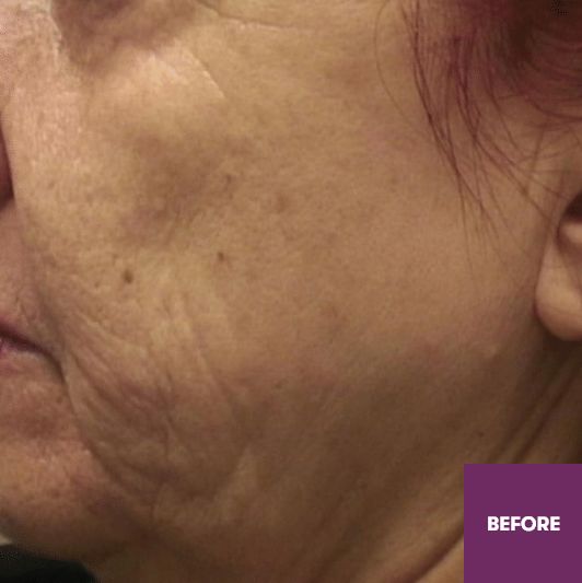 Result Before Treatment