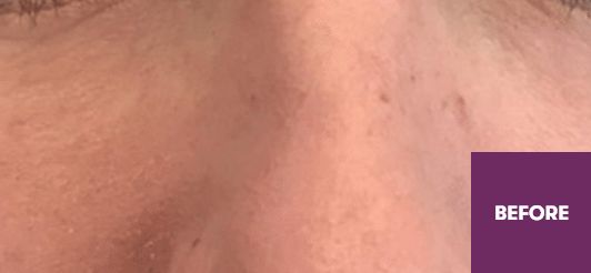 Result Before Treatment