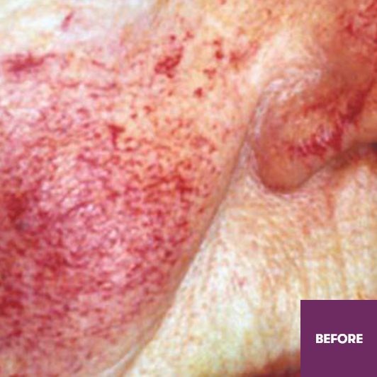 Result Before Treatment