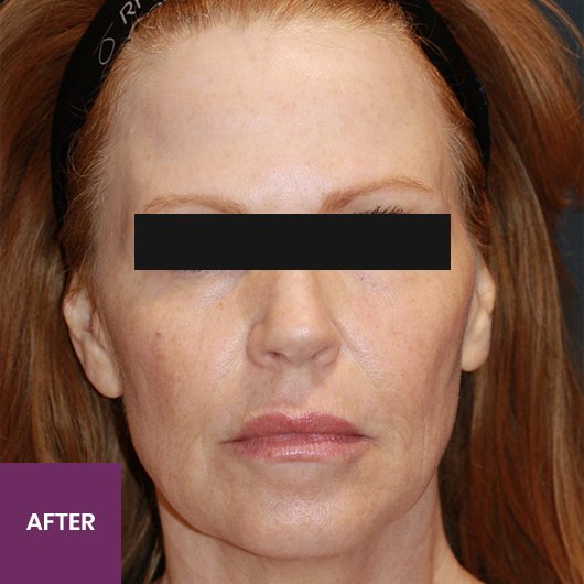 Result After Treatment