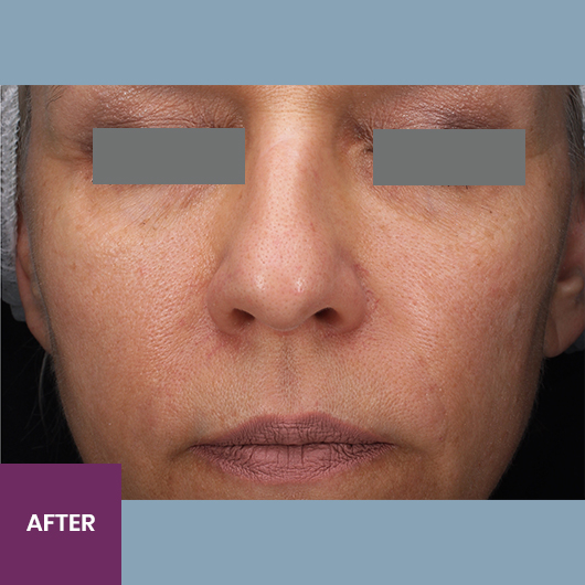 Result After Treatment