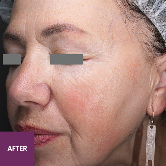 Result After Treatment