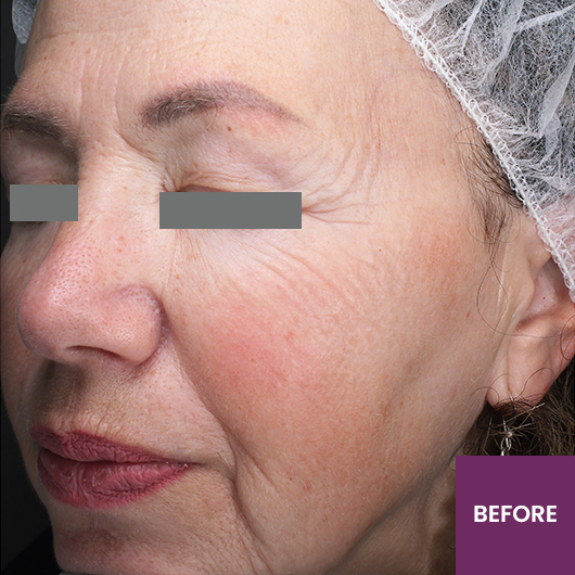 Result Before Treatment