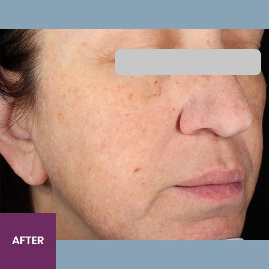 Result After Treatment