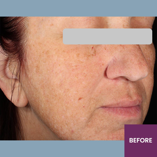 Result Before Treatment